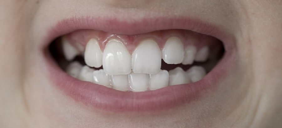 Antes